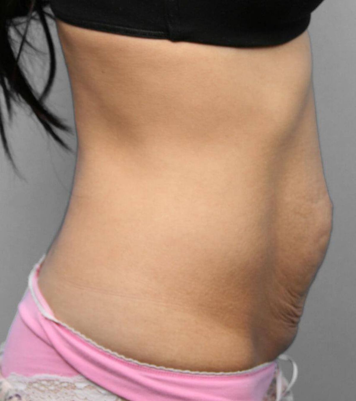Case 1691 — Oblique before