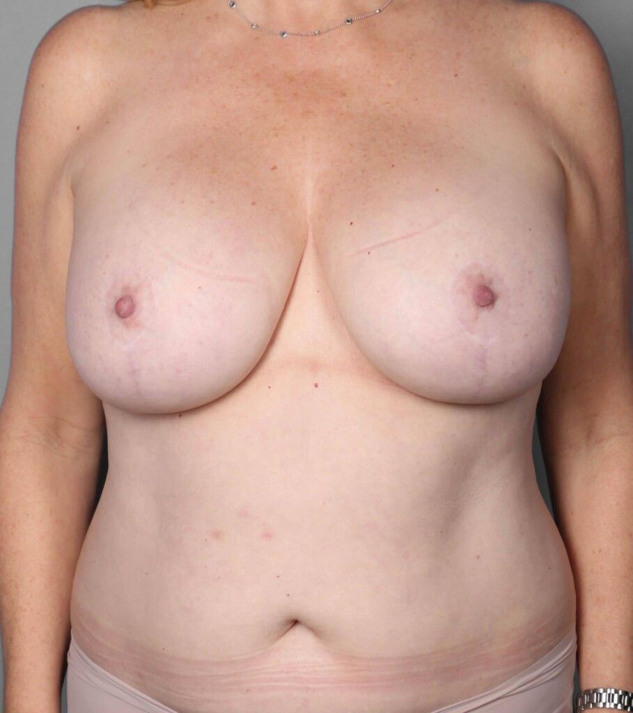 Before — Breast Implant Removal (Explant)