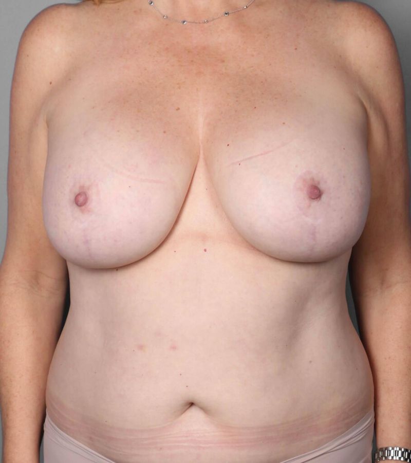Before — Breast Lift