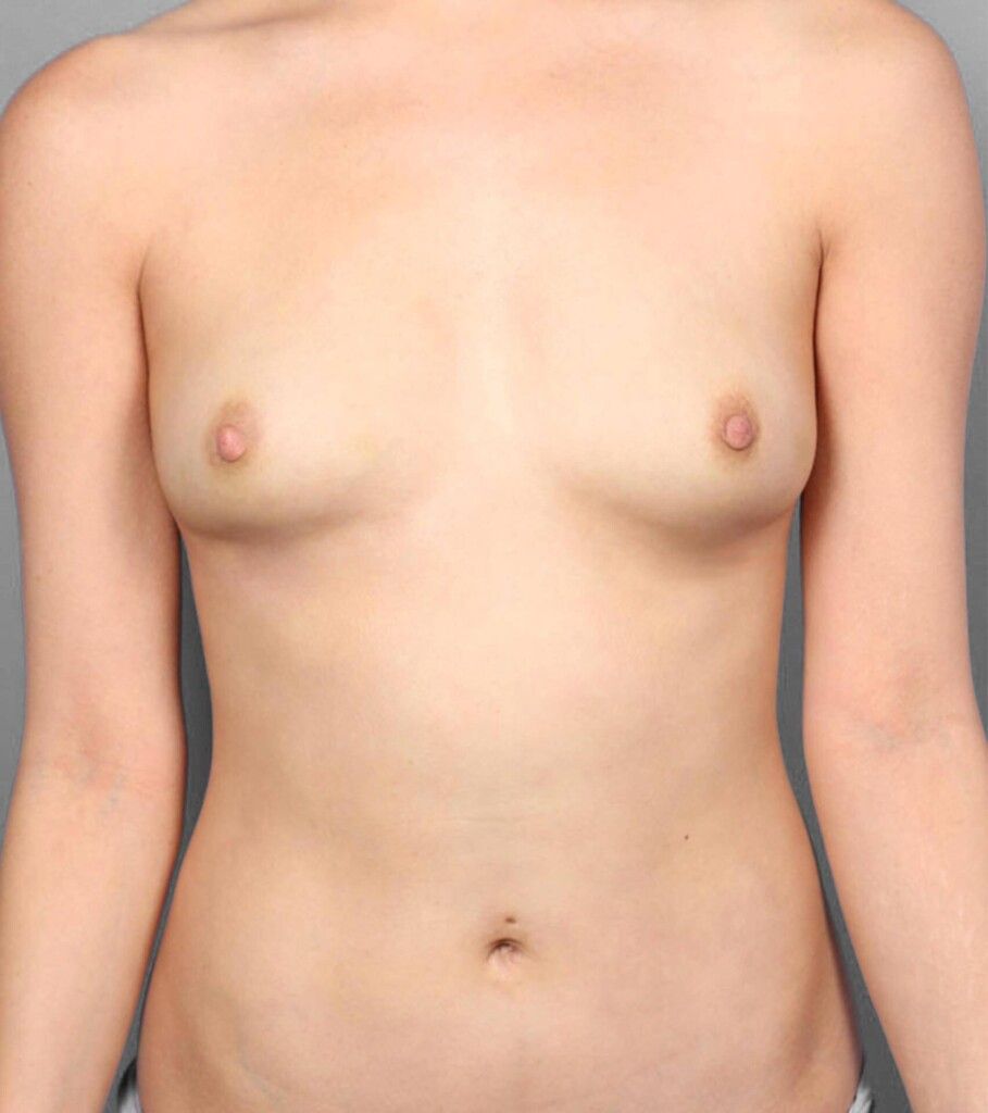 After implant removal with fat transfer to the breasts, front view, case 1344