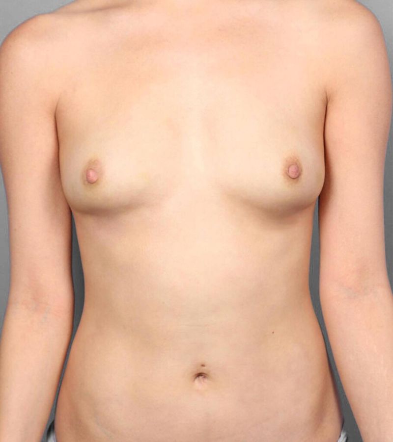 After — Breast Implant Removal (Explant)