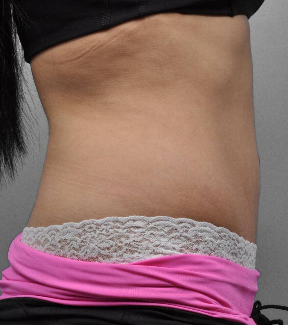 Case 1691 — Oblique after