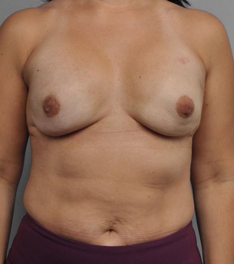 After — Direct-to-Implant Reconstruction