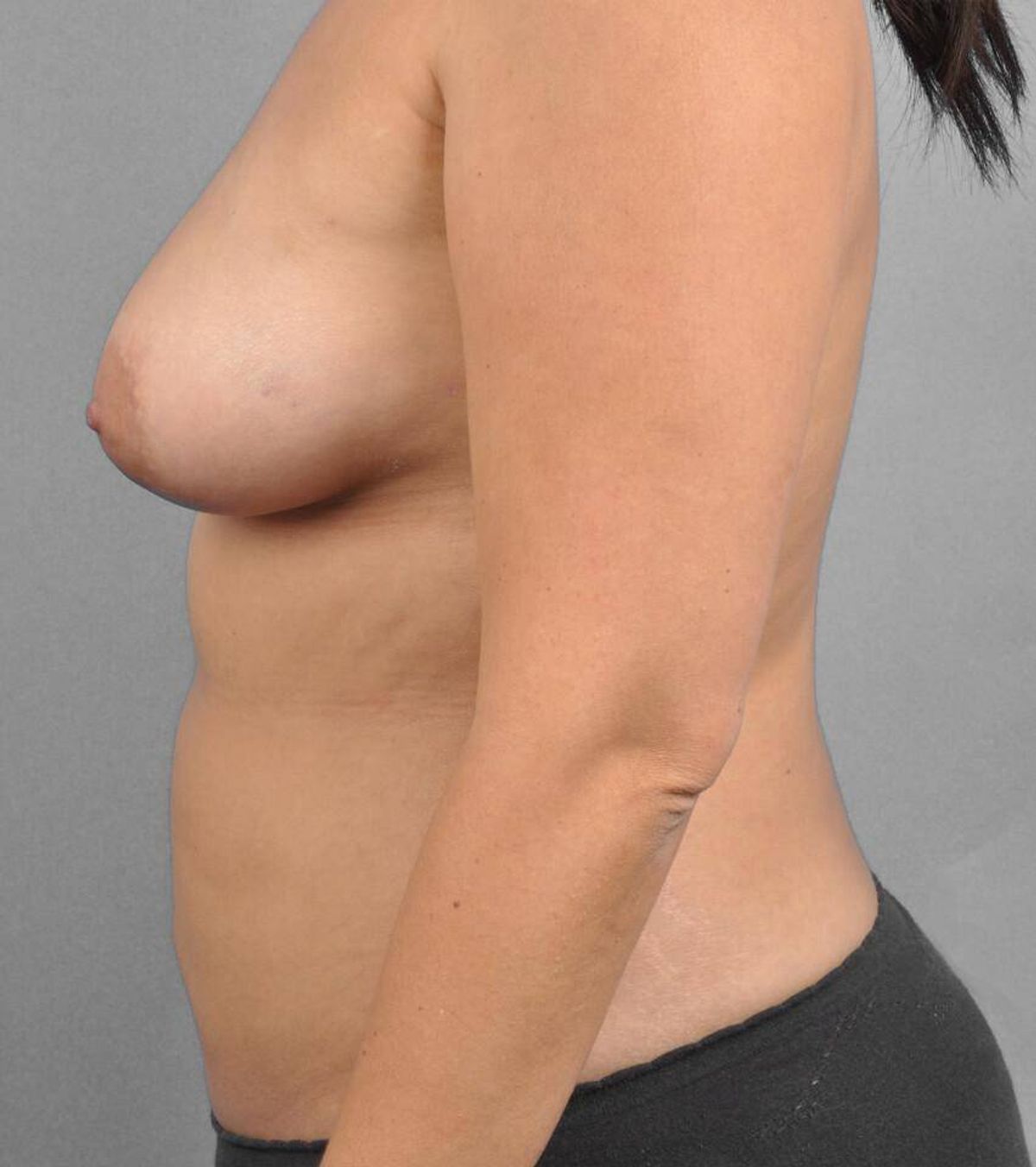 Case 1565 — Oblique after