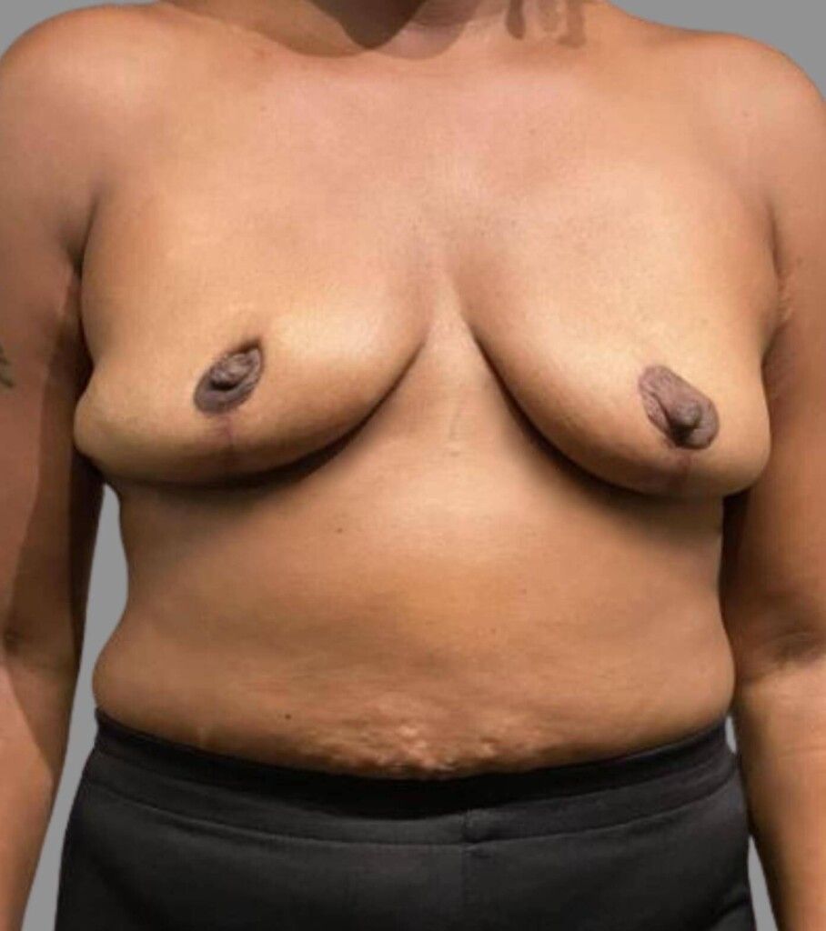 After — SWIM Flap Reconstruction
