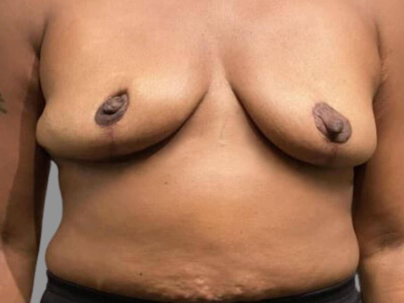 After — SWIM Flap Reconstruction