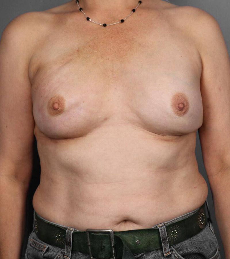 Before — Direct-to-Implant Reconstruction