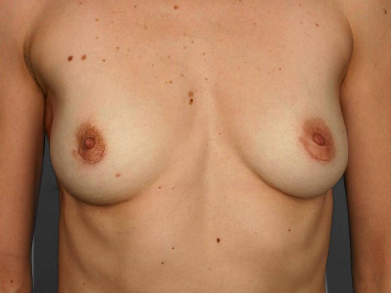 After — Breast Implant Removal (Explant)