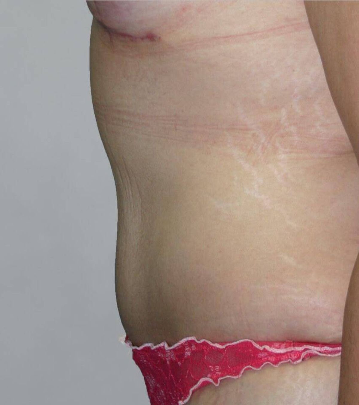 Case 1690 — Oblique after