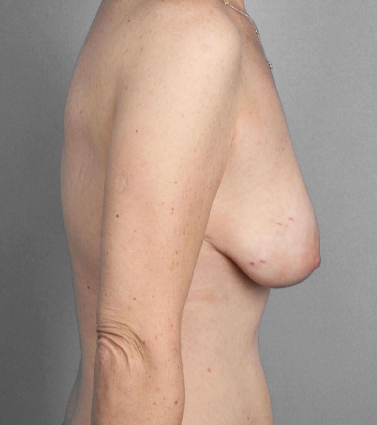 Case 1265 — Oblique before