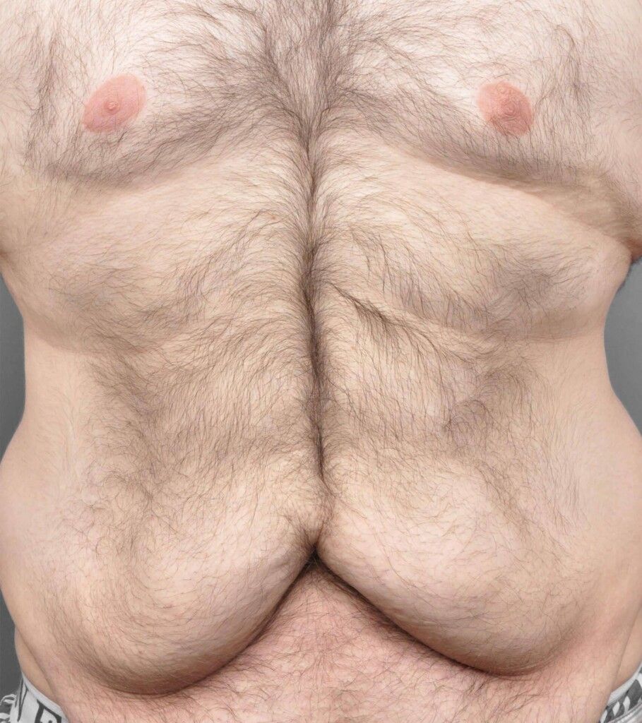 Before — Tummy Tuck