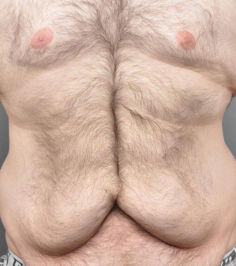 Before — Tummy Tuck
