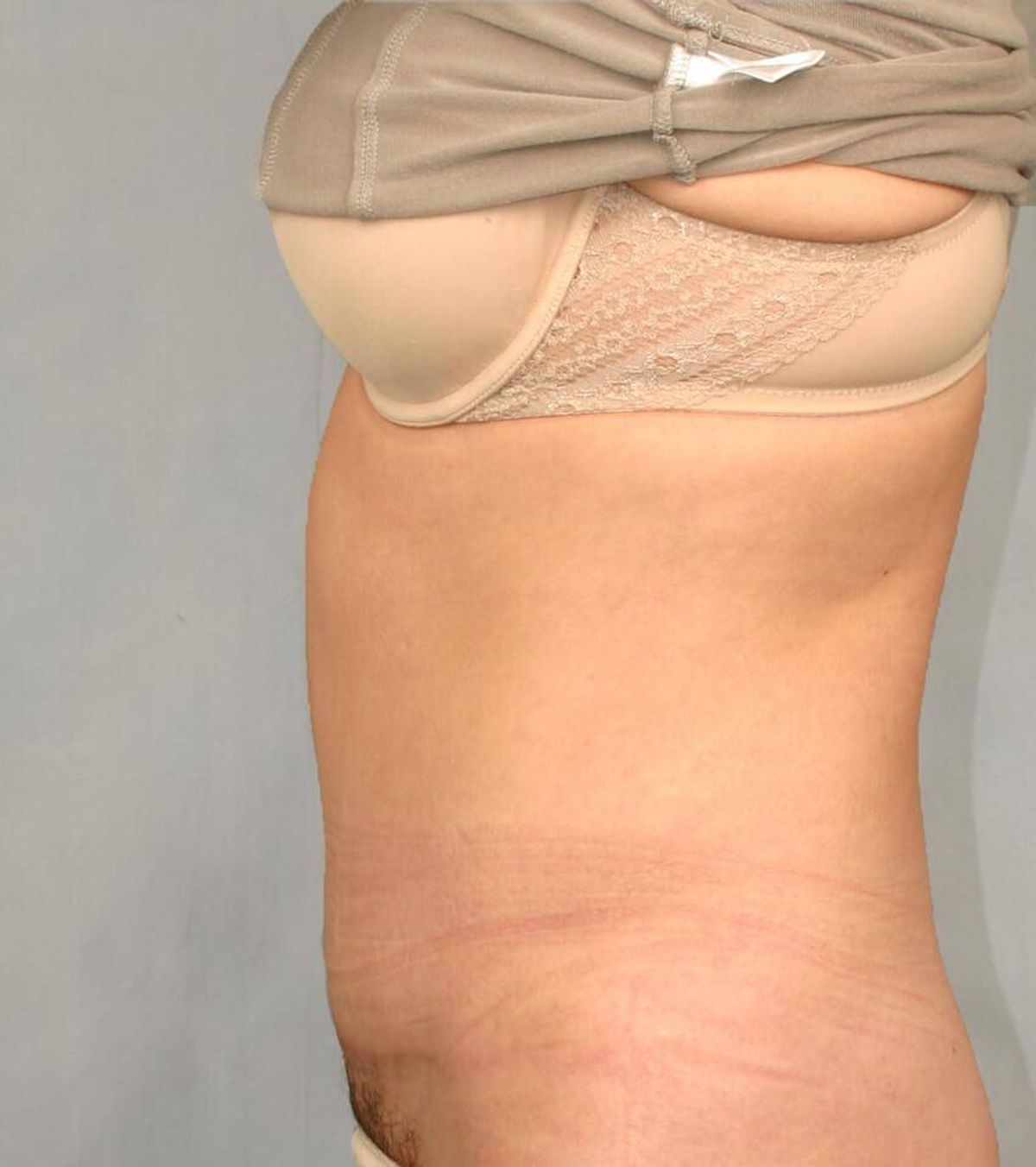 Case 1671 — Oblique after