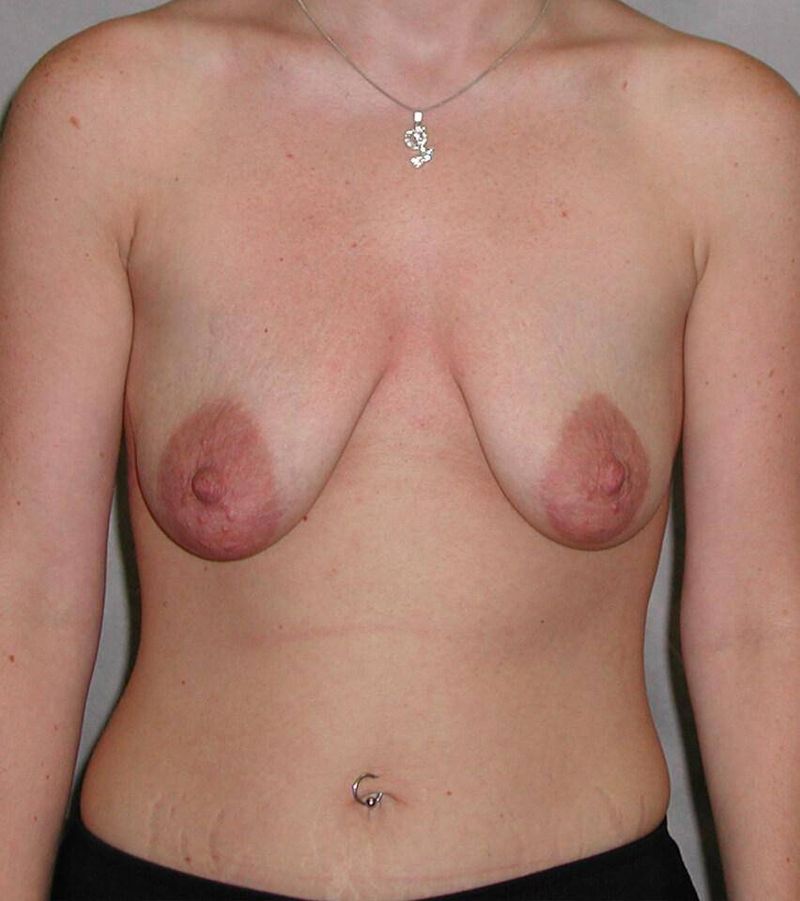 Before — Breast Augmentation