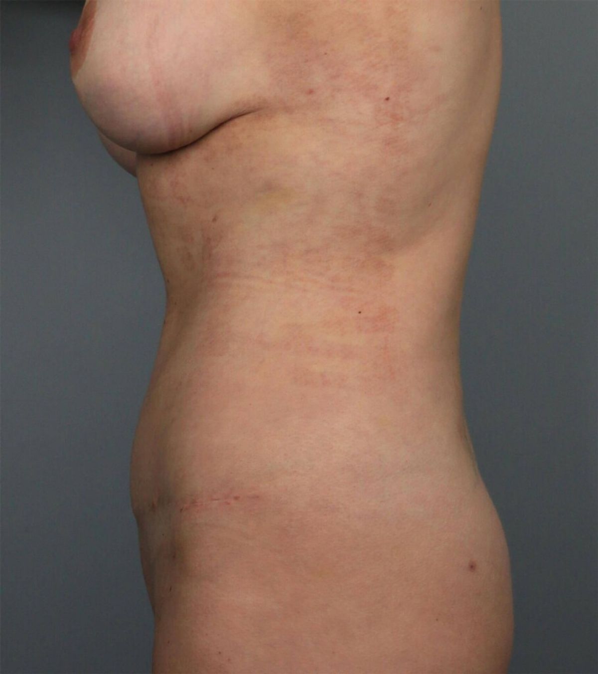 Case 1700 — Oblique after
