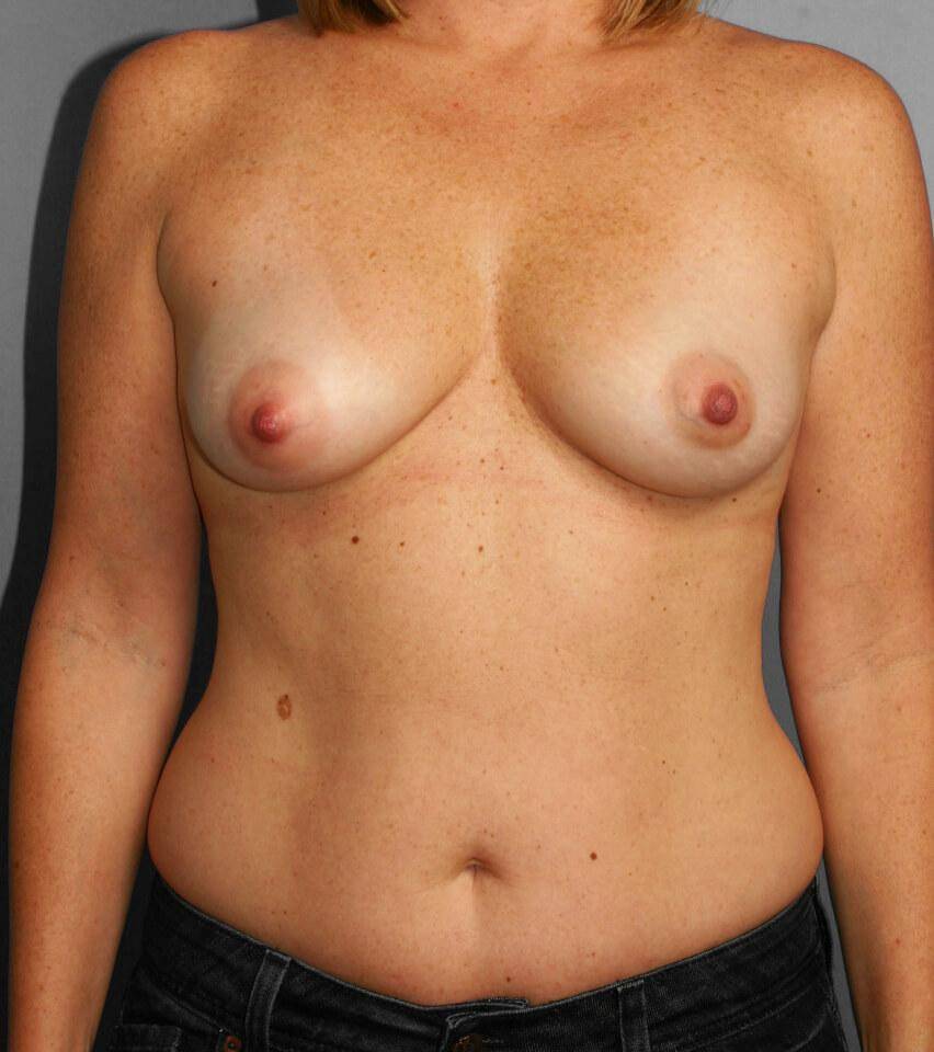 Before — Liposuction