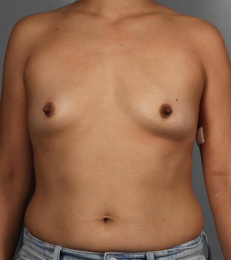 Before — Direct-to-Implant Reconstruction