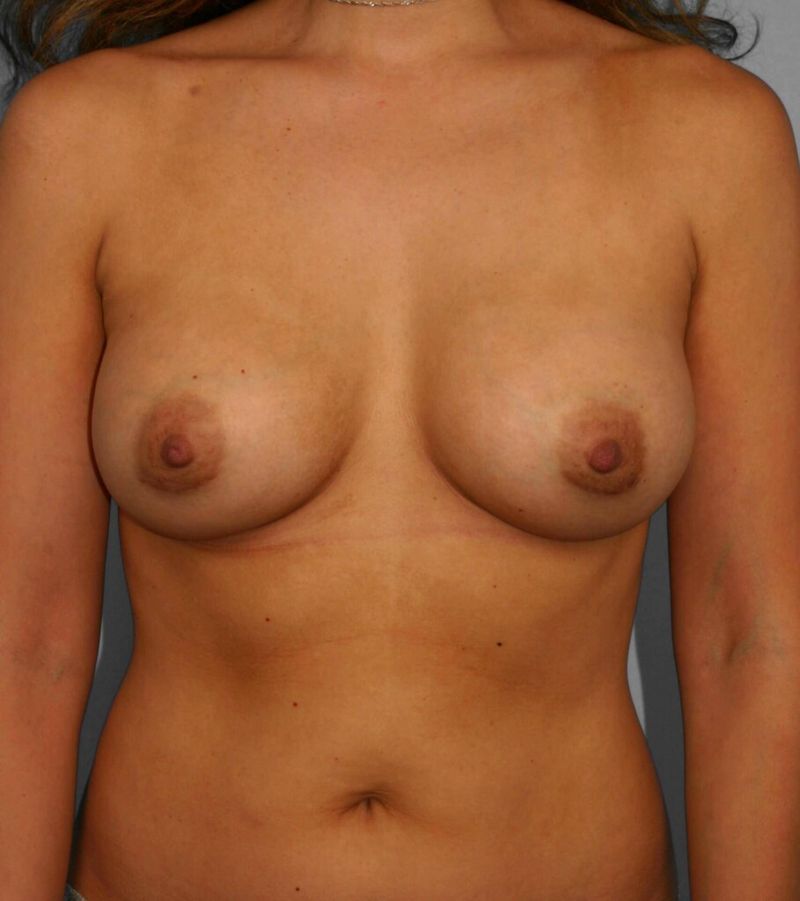 After — Breast Augmentation