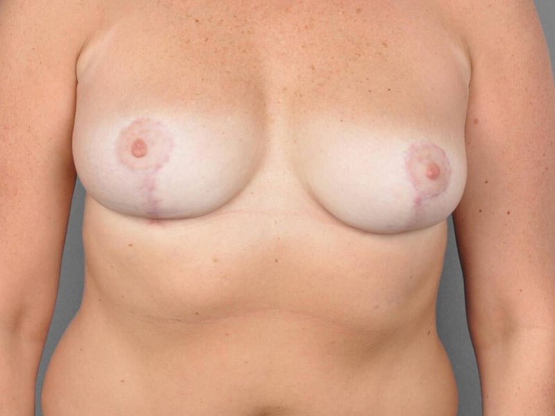 After — Breast Reduction