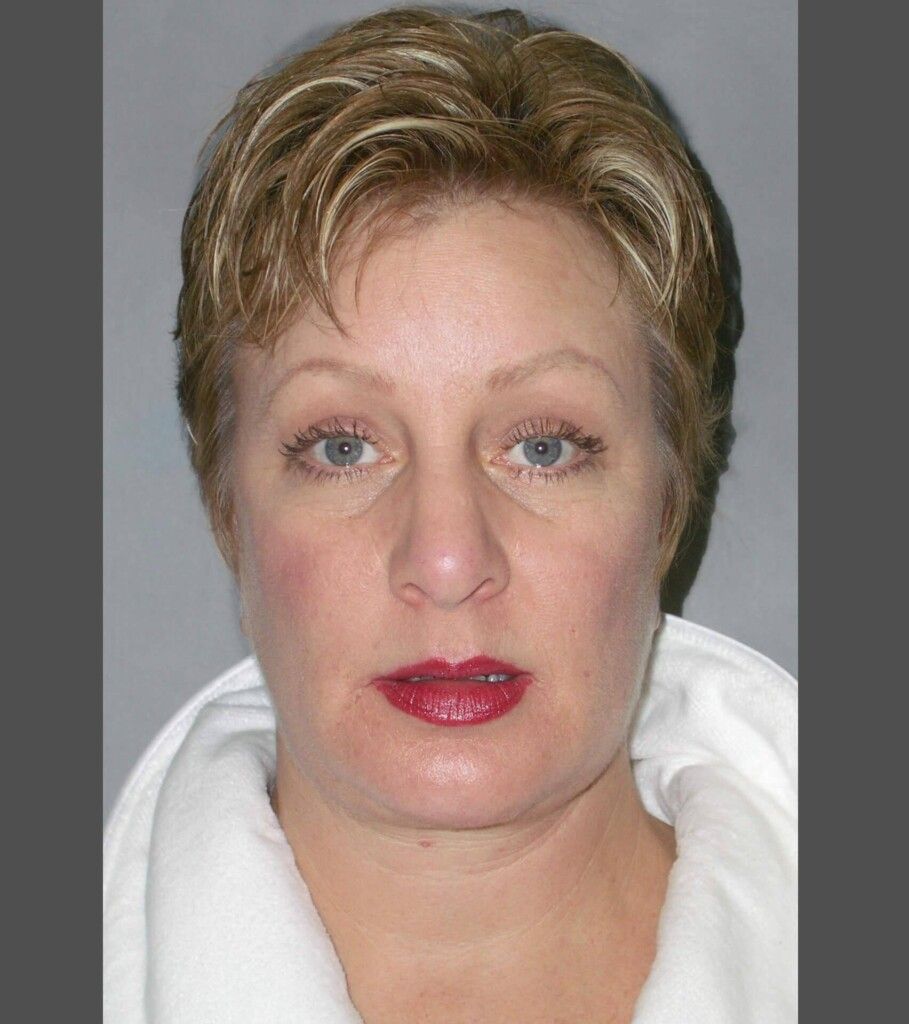 After — Facelift