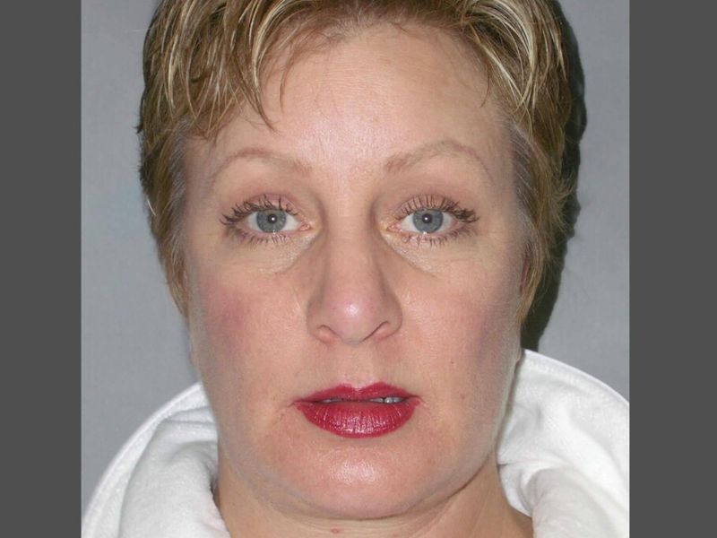 After — Facelift