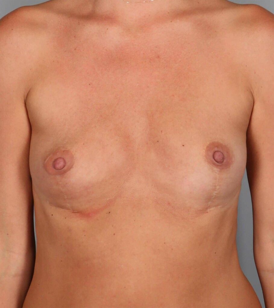 Before — Fat Transfer Breast Augmentation