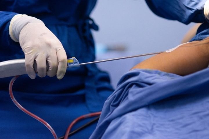 The 6 Most Common Questions About Liposuction Answered