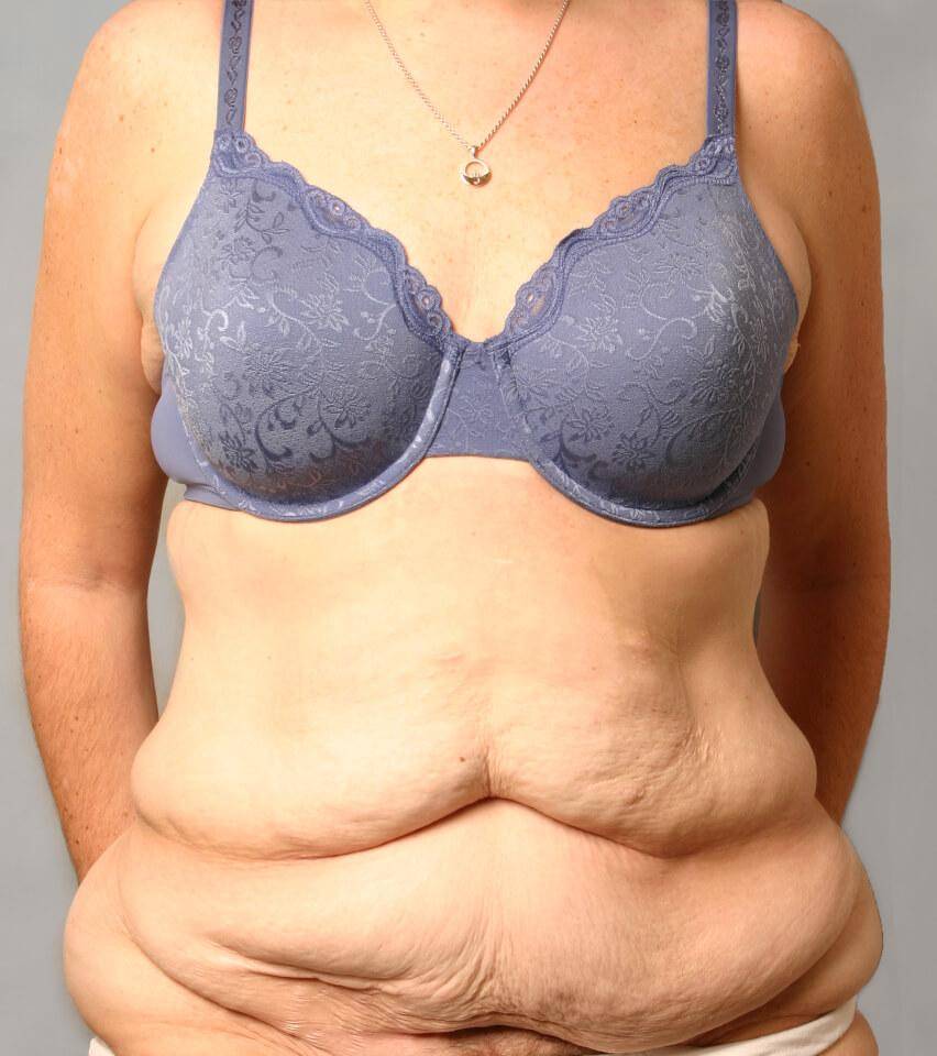 Before — Tummy Tuck