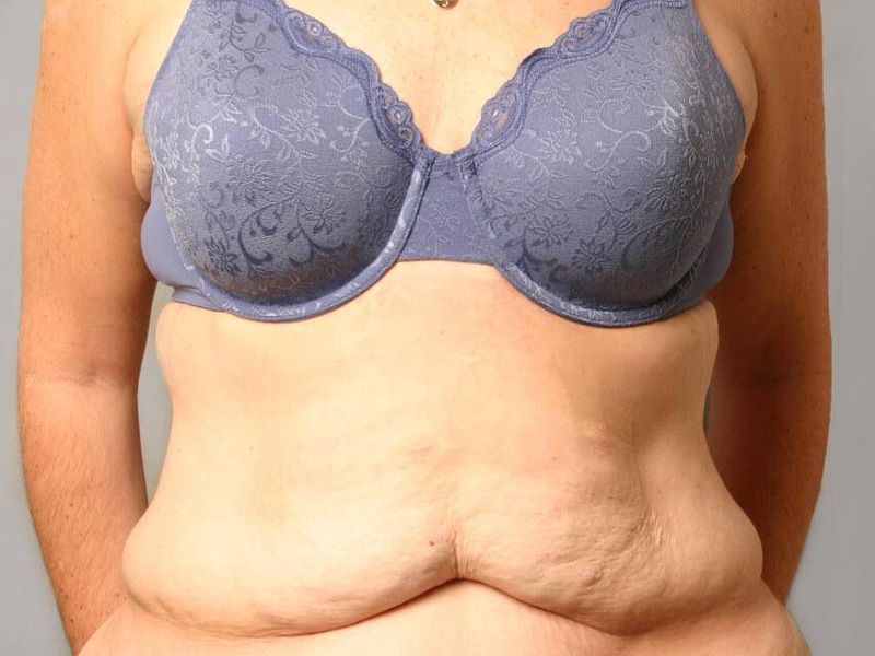 Before — Tummy Tuck