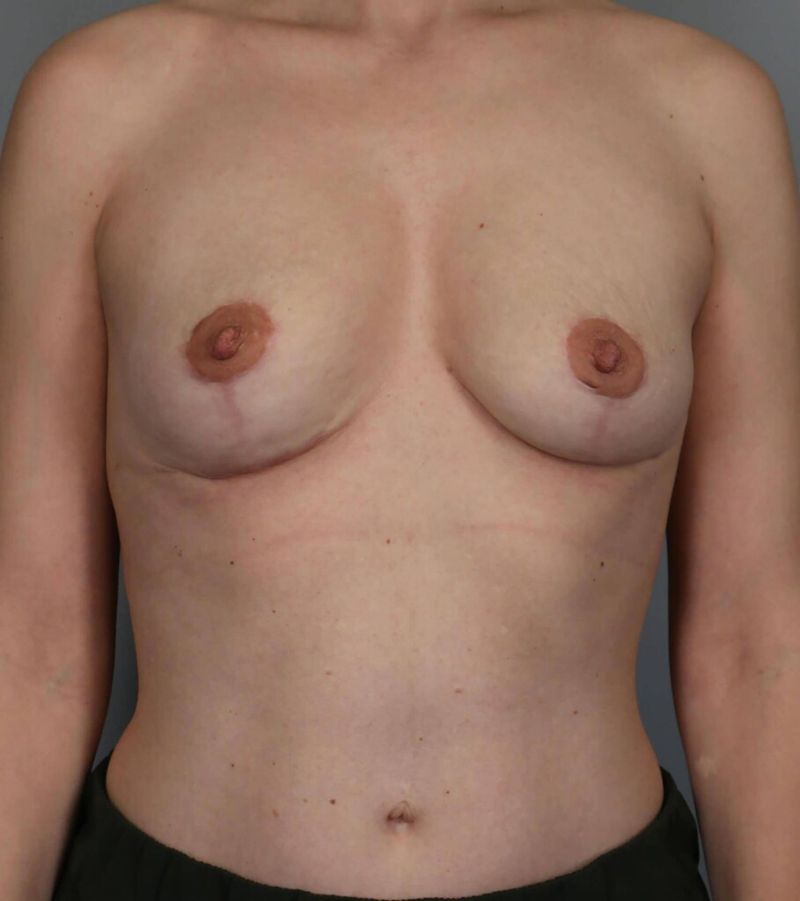 After — Breast Implant Removal (Explant)
