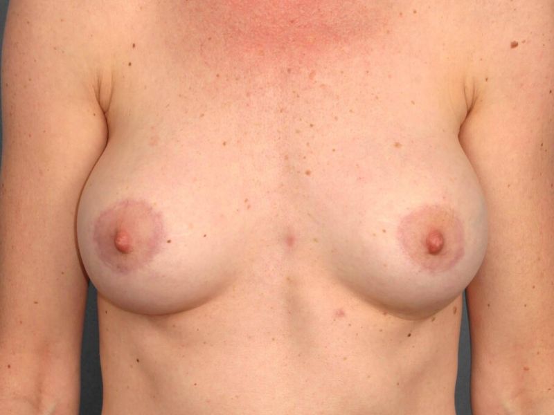 After — Breast Implant Replacement