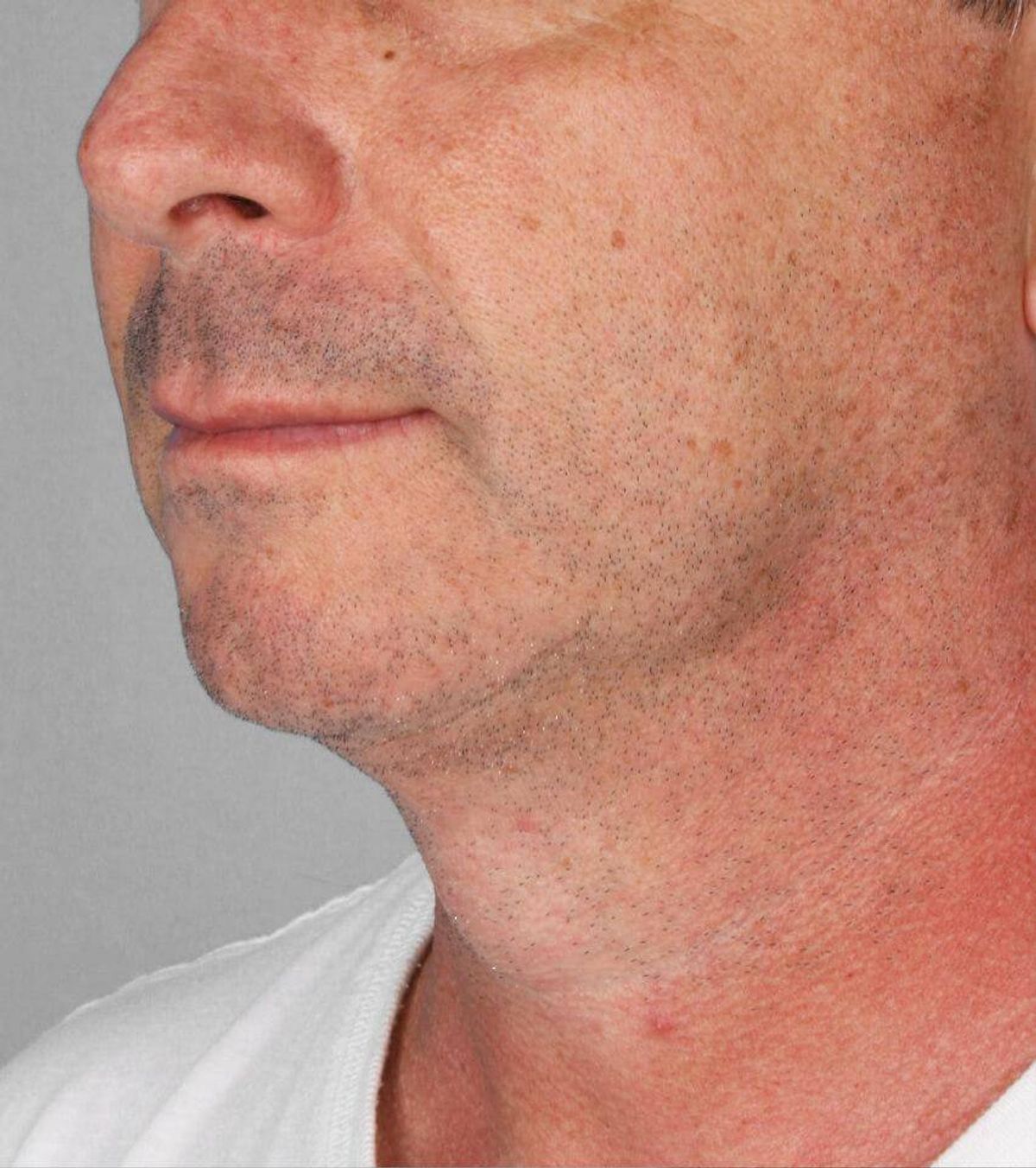 Case 1670 — Side after