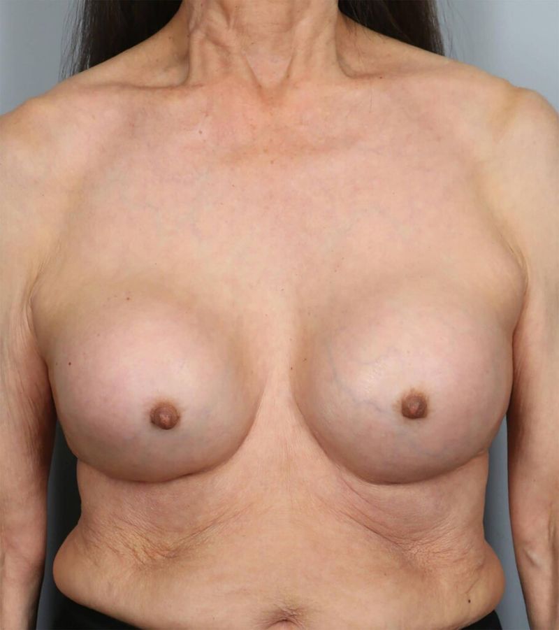 Before — Breast Implant Replacement