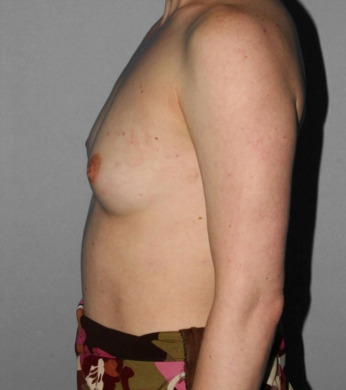 Case 1291 — Oblique before