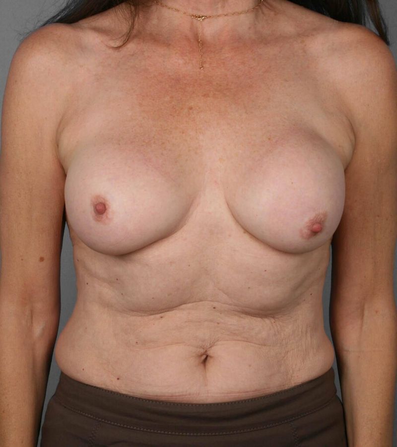 After — Fat Grafting Breast Reconstruction