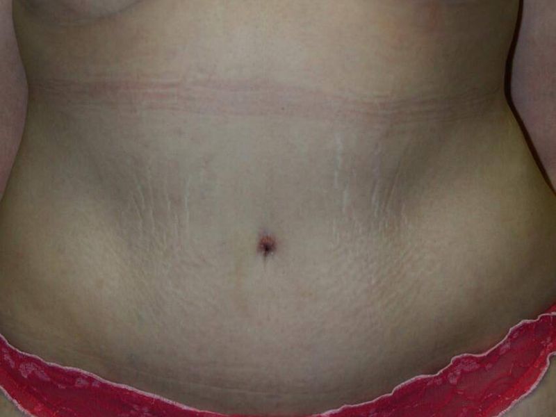 After — Tummy Tuck