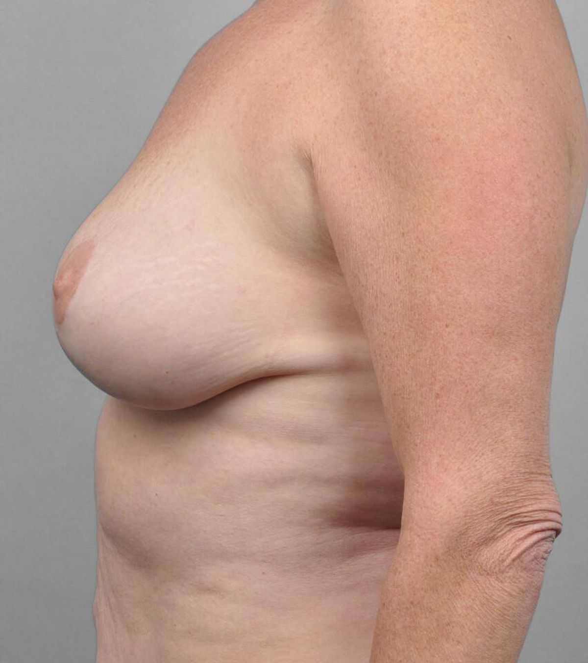 Case 1485 — Oblique after