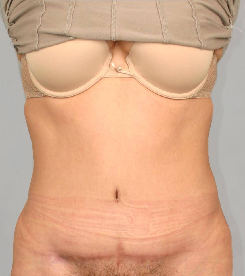 After — Liposuction