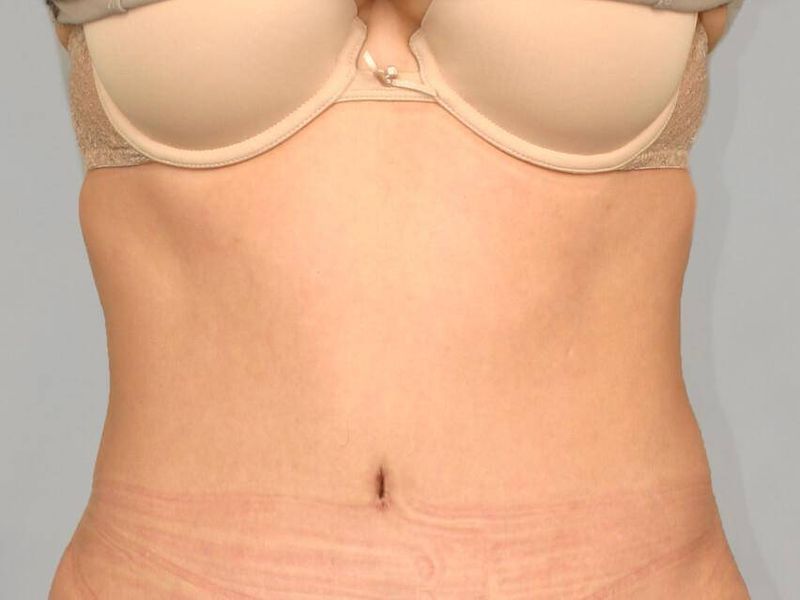 After — Tummy Tuck
