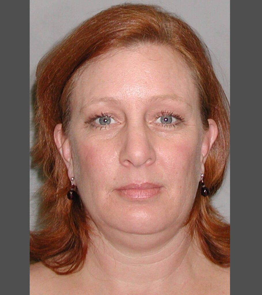 Before — Facelift