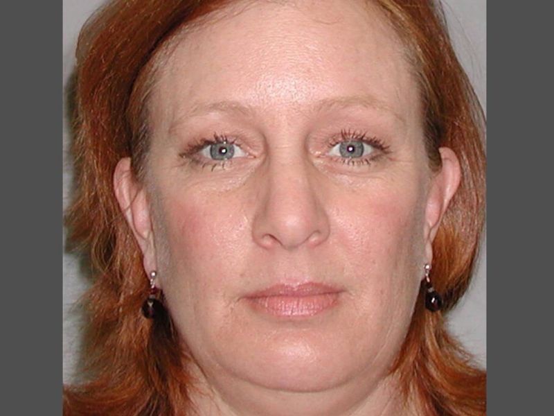 Before — Facelift