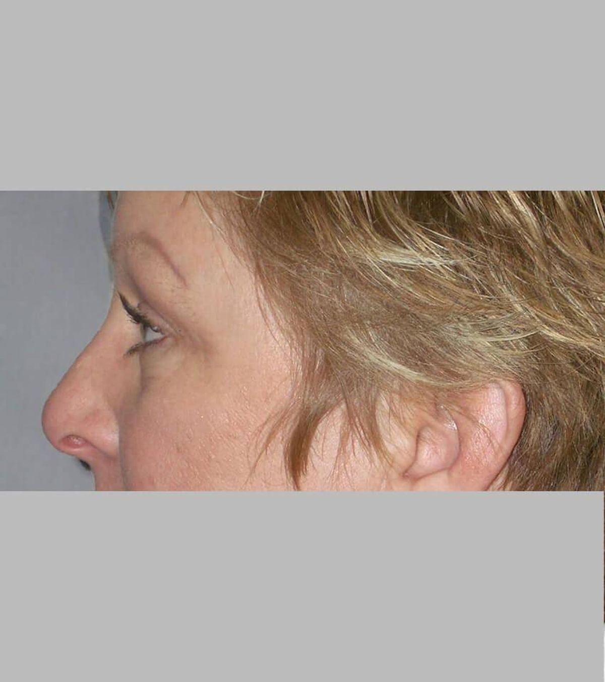 Case 1775 — Oblique after