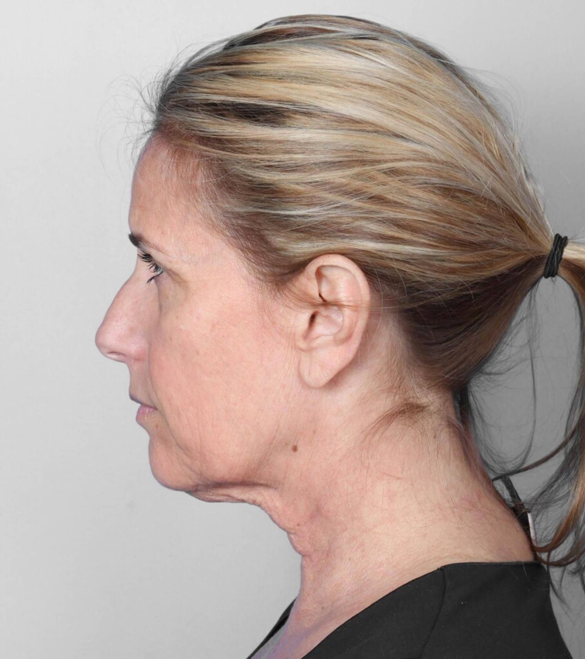Case 1782 — Oblique before