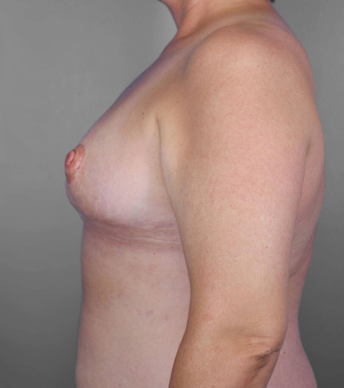 Case 1387 — Oblique after