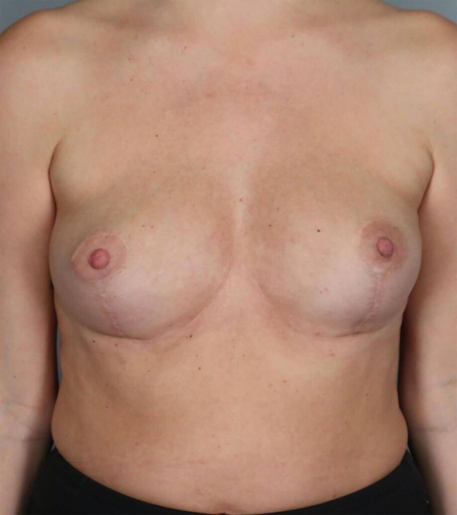 After — Fat Transfer Breast Augmentation