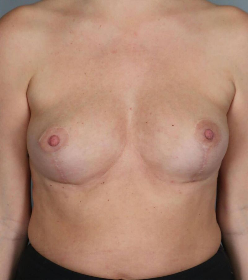 After — Fat Transfer Breast Augmentation