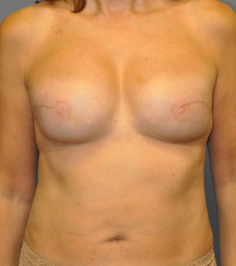 After — Fat Grafting Breast Reconstruction