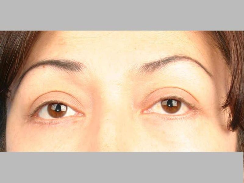Before — Blepharoplasty