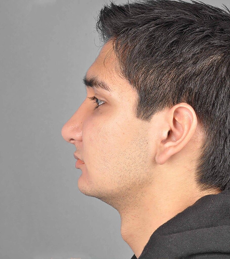 After — Rhinoplasty