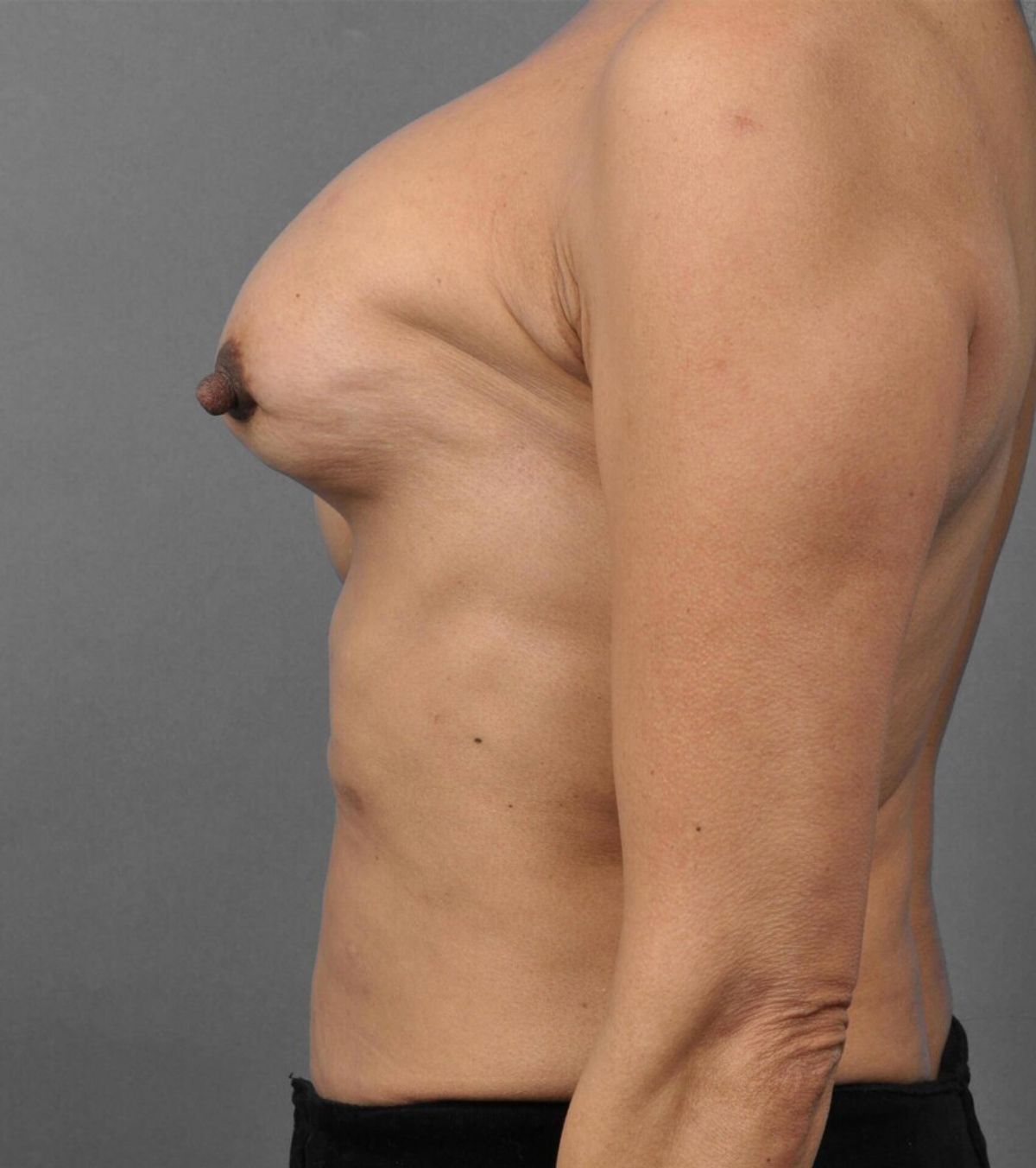 Case 1487 — Oblique before